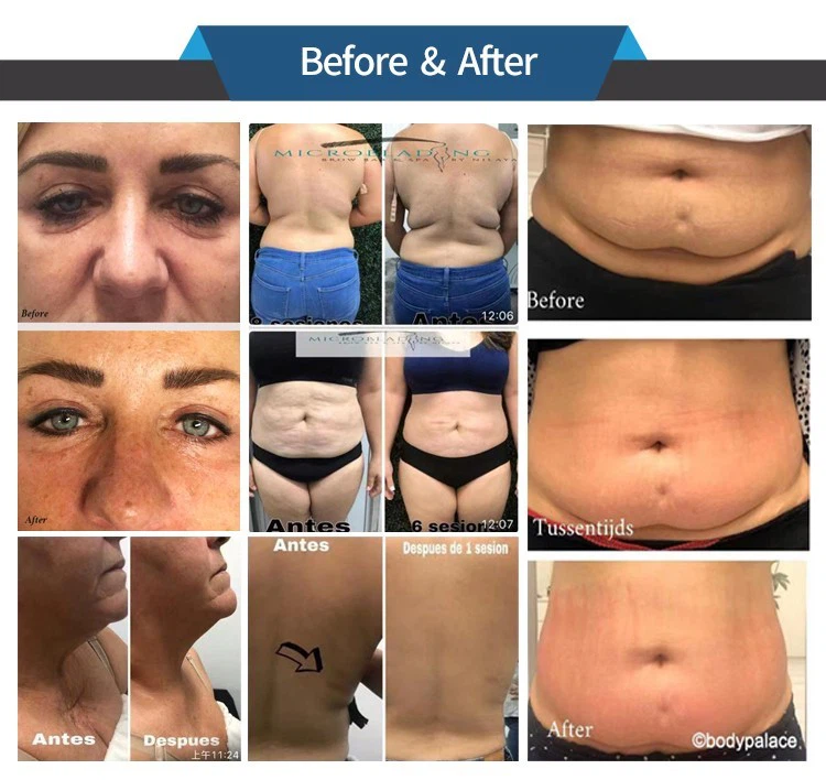 velashape before after photos 5