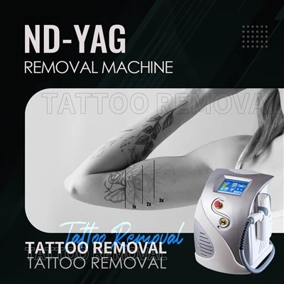 ND: لیزر YAG 1064NM دستگاه حذف خال کوبی